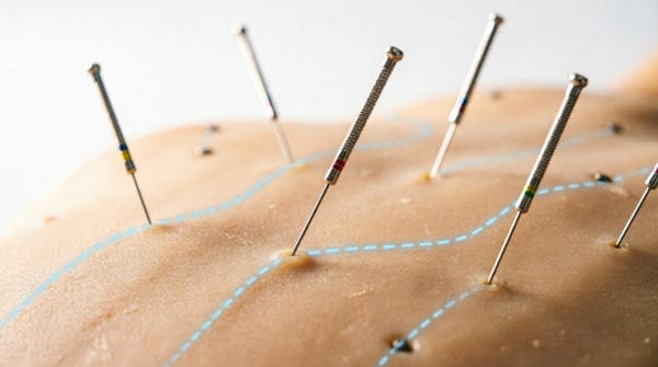 Close-up of sterile acupuncture needles inserted at meridian points showing proper technique and fine needle gauge used in traditional Chinese medicine treatment